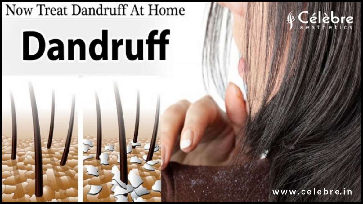 Stop Dandruff Problems Immediately with These dandruff Home Remedies