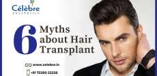 6 Myths about Hair Transplant