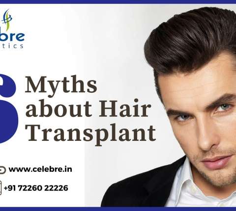 6 Myths about Hair Transplant