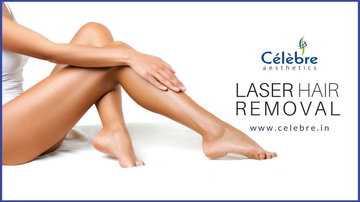 Points to Consider Before Opting for Laser Hair Removal Treatment