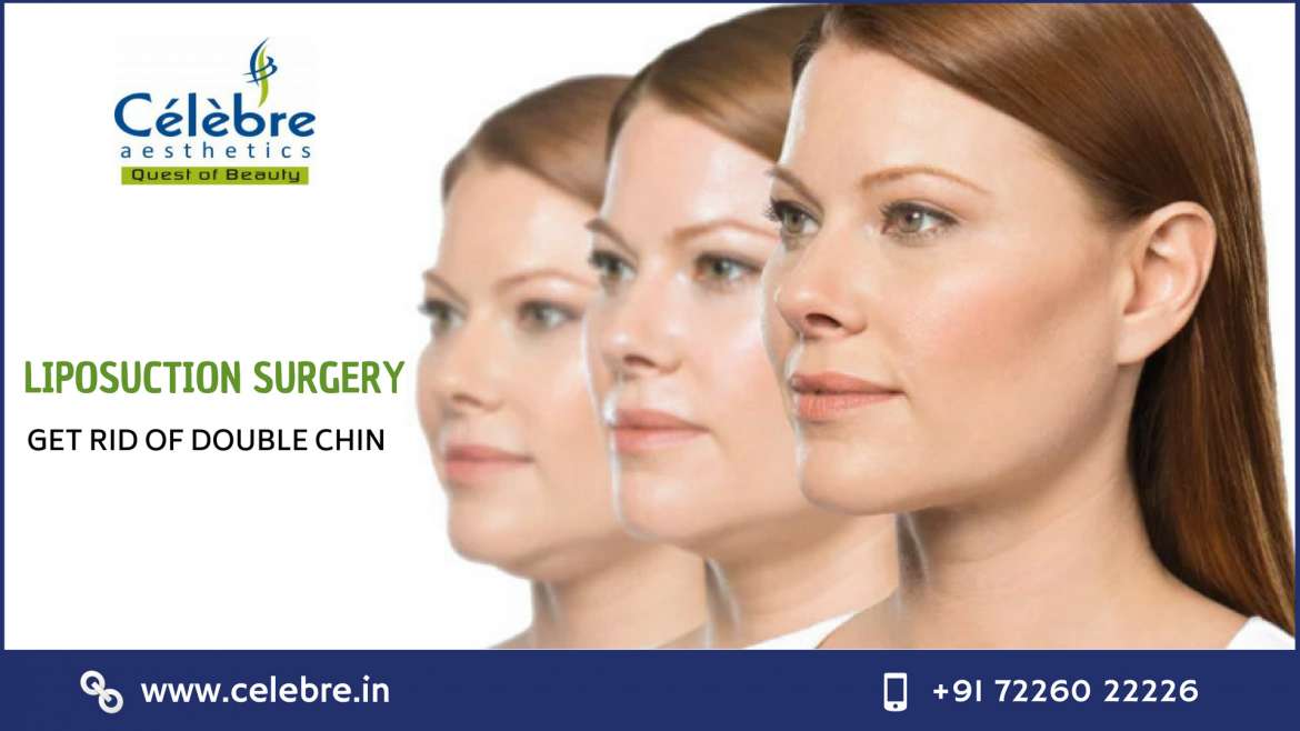 Liposuction Surgery in Surat – Best Place to Get Rid of Double Chin