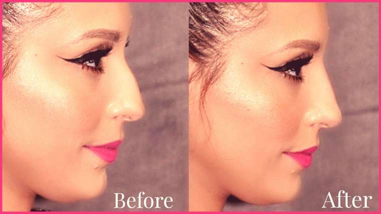 Non-Surgical Nose Job treatment in Surat