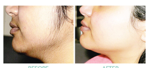 Laser hair removal in Surat