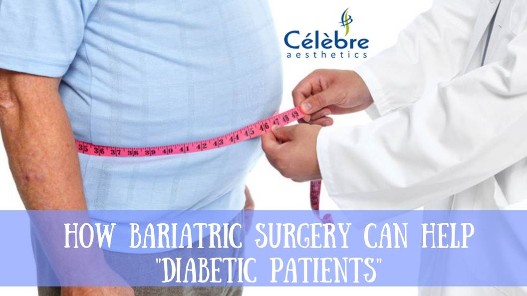 How Bariatric Surgery in Surat Can Help Diabetic Patients