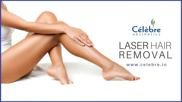 Points to Consider Before Opting for Laser Hair Removal Treatment