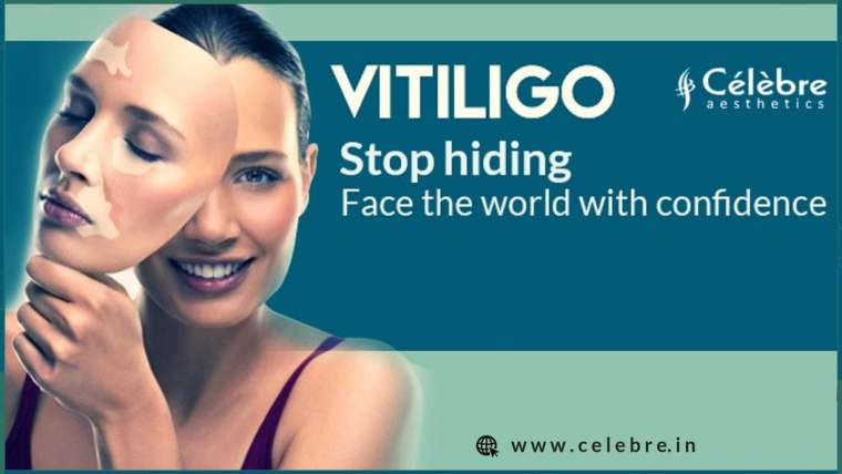 Vitiligo Definition, symptoms and Treatment